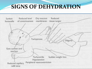 SIGNS OF DEHYDRATION
 