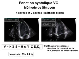 4 cavités et 2 cavités : méthode biplan  V = H    S = H    /4    D 1 D 2 Où H hauteur des disques S surface de chaque tranche D 1 D 2  diamètre de chaque tranche Normale: 55 - 75 % Fonction systolique VG  Méthode de Simpson 
