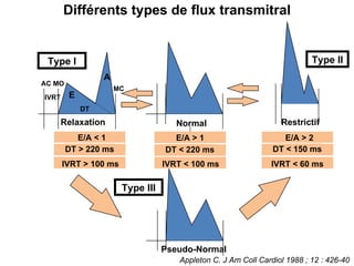 AC MO MC IVRT Normal Restrictif Appleton C. J Am Coll Cardiol 1988 ; 12 : 426-40 Relaxation E A Pseudo-Normal Type I Type II Type III IVRT < 100 ms DT < 220 ms E/A > 1  IVRT > 100 ms DT > 220 ms E/A < 1 IVRT < 60 ms DT < 150 ms E/A > 2 DT Différents types de flux transmitral 