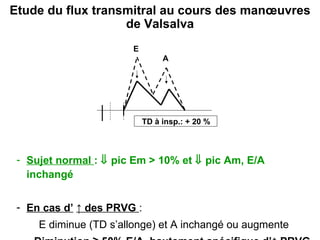 Etude du flux transmitral au cours des manœuvres de Valsalva Sujet normal  :    pic Em > 10% et    pic Am, E/A inchangé E n cas d’   ↑ des PRVG  :  E diminue (TD s’allonge) et A inchangé ou augmente  ->   Diminution ≥ 50% E/A, hautement spécifique d’↑ PRVG E A TD à insp.: + 20 % 
