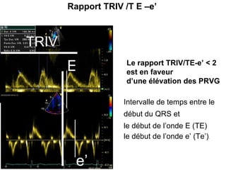 E e’ TRIV Rapport TRIV /T E –e’ Le rapport TRIV/TE-e’ < 2  est en faveur  d’une élévation des PRVG Intervalle de temps entre le  début du QRS et  le début de l’onde E (TE)  le début de l’onde e’ (Te’) .  