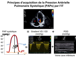 POD (mmHg) VCI = + Principes d’acquisition de la Pression Artérielle  Pulmonaire Systolique (PAPs) par l’IT Flux d’insuffisance  tricuspide PAP systolique (mmHg) Gradient VD / OD (mmHg) VCI = + 10 20 30 mmHg 50 40 60 AP ∆ P Veine cave inférieure OD VD 