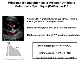 Vmax de l’IP = gradient diastolique VD / AP (mmHg) PAP = gradient VD / AP + pression OD Intérêt : IP analysable chez 60 à 75 % des patients Méthode surtout utile si l’IT n’est pas analysable PAP diastolique = 4 V 2   2  + POD PAP moyenne  = 4 V 1   2  + POD PAP systolique = 3 PAPm – 2 PAPd VD AP AO Principes d’acquisition de la Pression Artérielle  Pulmonaire Systolique (PAPs) par l’IP V1 V2 