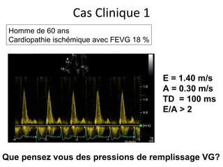 Homme de 60 ans Cardiopathie ischémique avec FEVG 18 % Que pensez vous des pressions de remplissage VG? Cas Clinique 1 E = 1.40 m/s A = 0.30 m/s TD  = 100 ms E/A > 2 