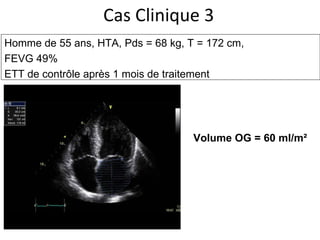 Cas Clinique 3 Homme de 55 ans, HTA,  Pds = 68 kg, T = 172 cm,  FEVG 49% ETT de contrôle après 1 mois de traitement Volume OG = 60 ml/m² 