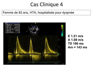 Cas Clinique 4 Femme de 82 ans, HTA, hospitalisée pour dyspnée E 1.21 m/s A 1.08 m/s TD 196 ms Am = 143 ms 