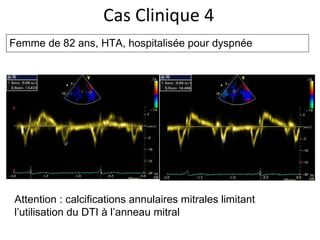 Cas Clinique 4 Femme de 82 ans, HTA, hospitalisée pour dyspnée Attention : calcifications annulaires mitrales limitant l’utilisation du DTI à l’anneau mitral 