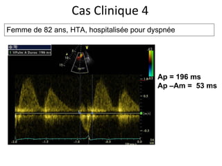 Cas Clinique 4 Femme de 82 ans, HTA, hospitalisée pour dyspnée Ap = 196 ms Ap –Am =  53 ms  
