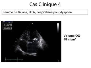 Cas Clinique 4 Femme de 82 ans, HTA, hospitalisée pour dyspnée Volume OG  48 ml/m² 