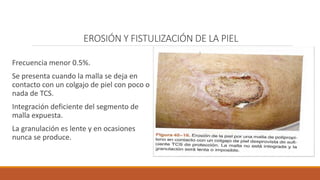 EROSIÓN Y FISTULIZACIÓN DE LA PIEL
Frecuencia menor 0.5%.
Se presenta cuando la malla se deja en
contacto con un colgajo de piel con poco o
nada de TCS.
Integración deficiente del segmento de
malla expuesta.
La granulación es lente y en ocasiones
nunca se produce.
 