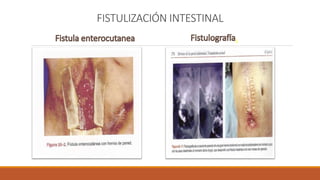 FISTULIZACIÓN INTESTINAL
.
 