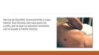 Hernia de Grynfelt. Acercamiento y vista
lateral. Son hernias con saco pero sin
cuello, por lo que su volumen aumenta
con el pujido o llanto intenso.
 