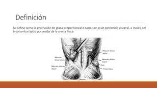 Definición
Se define como la protrusión de grasa preperitoneal o saco, con o sin contenido visceral, a través del
área lumbar justo por arriba de la cresta iliaca
 