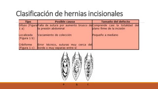 Clasificación de hernias incisionales
a b c
 