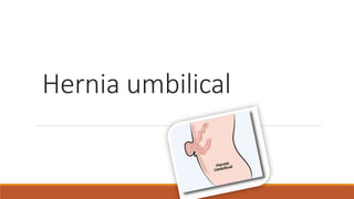 Hernia umbilical
 