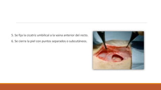 5. Se fija la cicatriz umbilical a la vaina anterior del recto.
6. Se cierra la piel con puntos separados o subcutáneos.
 