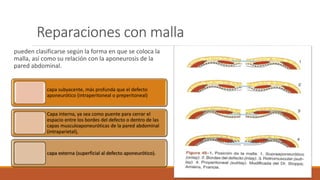 Reparaciones con malla
pueden clasificarse según la forma en que se coloca la
malla, así como su relación con la aponeurosis de la
pared abdominal.
capa subyacente, más profunda que el defecto
aponeurótico (intraperitoneal o preperitoneal)
Capa interna, ya sea como puente para cerrar el
espacio entre los bordes del defecto o dentro de las
capas musculoaponeuróticas de la pared abdominal
(intraparietal),
capa externa (superficial al defecto aponeurótico).
 