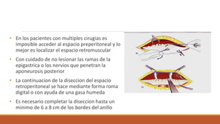 • En los pacientes con multiples cirugias es
imposible acceder al espacio preperitoneal y lo
mejor es localizar el espacio retromuscular
• Con cuidado de no lesionar las ramas de la
epigastrica o los nervios que penetran la
aponeurosis posterior
• La continuacion de la diseccion del espacio
retroperitoneal se hace mediante forma roma
digital o con ayuda de una gasa humeda
• Es necesario completar la diseccion hasta un
minimo de 6 a 8 cm de los bordes del anillo
 