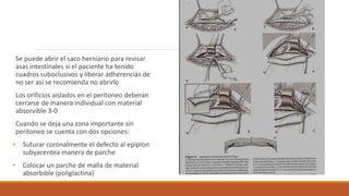Se puede abrir el saco herniario para revisar
asas intestinales si el paciente ha tenido
cuadros suboclusivos y liberar adherencias de
no ser asi se recomienda no abrirlo
Los orificios aislados en el peritoneo deberan
cerrarse de manera individual con material
absorvible 3-0
Cuando se deja una zona importante sin
peritoneo se cuenta con dos opciones:
• Suturar coronalmente el defecto al epiplon
subyacentea manera de parche
• Colocar un parche de malla de material
absorbible (poliglactina)
 