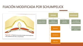 VENTAJAS
No se realizan
colgajos extras.
Menos
posibilidad de:
Seromas.
Hematoma.
Infección.
No deja
cicatrices.
DESVENTAJAS
La malla se
puede desplazar
cuando no esta
fija a estructuras
firmes.
 