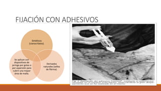 FIJACIÓN CON ADHESIVOS
Sintéticos
(cianocrilatos).
Derivados
naturales (sellos
de fibrina).
Se aplican con
dispositivos de
jeringa por gotas o
por aspersión para
cubrir una mayor
área de malla.
 