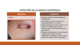 Diagnóstico:
• Clínico.
Tratamiento:
• Drenaje, lavado (solución fisiológica),
desbridación.
• La prótesis se revisa y si tiene una
adecuada fijación no se retira.
• Malla polipropileno puede dejarse en su
lugar en la mayoría de los casos,
presenta buen control de la infección y
granulación.
• Malla de multifilamento si no hay buena
integración de toda o en algún
segmento, se considera su retiro total o
parcial, sin realizar intento de plastia.
 