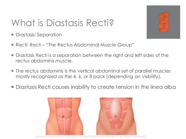 Diastasis - Prevention and Correction Diastasis - Prevention and Correction