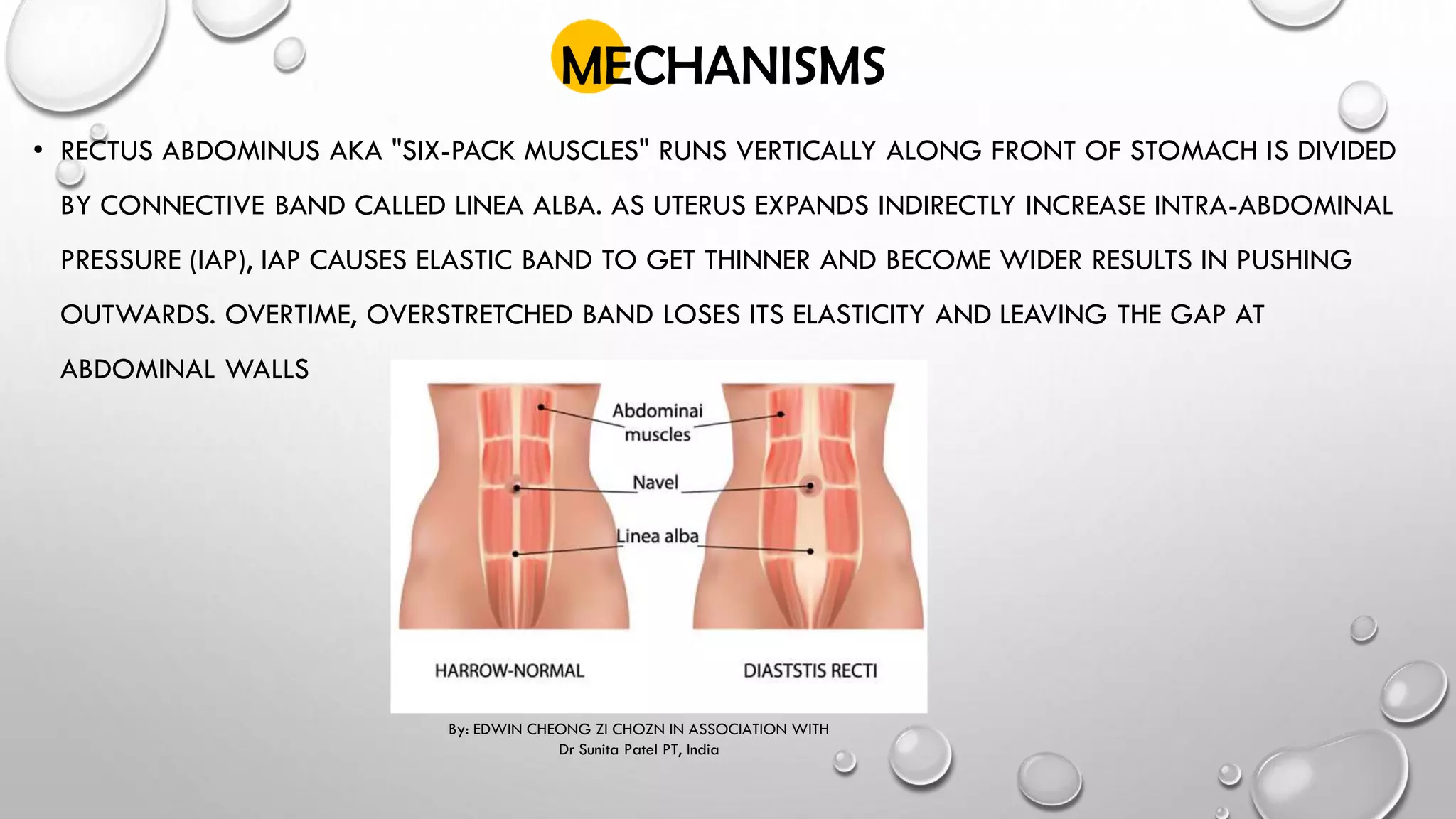 DIASTASIS RECTI - Edwin Cheong Zi Chozn.pdf