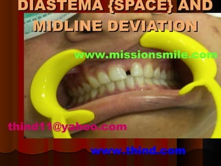 DIASTEMA {SPACE} AND MIDLINE DEVIATION www.thind.com [email_address] www.missionsmile.com 