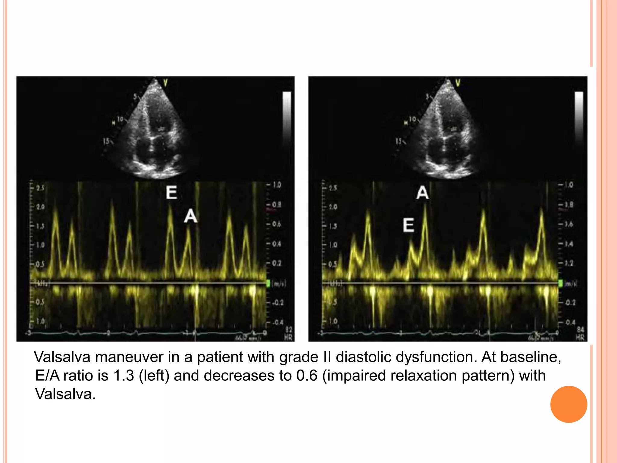 Valsalva maneuver in a patient with grade II diastolic dysfunction. At baseline,
E/A ratio is 1.3 (left) and decreases to 0.6 (impaired relaxation pattern) with
Valsalva.
 