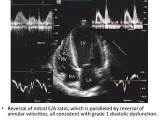 Diastolic Dysfunction Evaluation Pptx