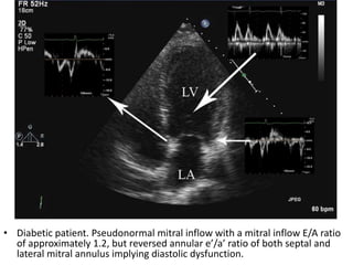 Diastolic Dysfunction Evaluation Pptx