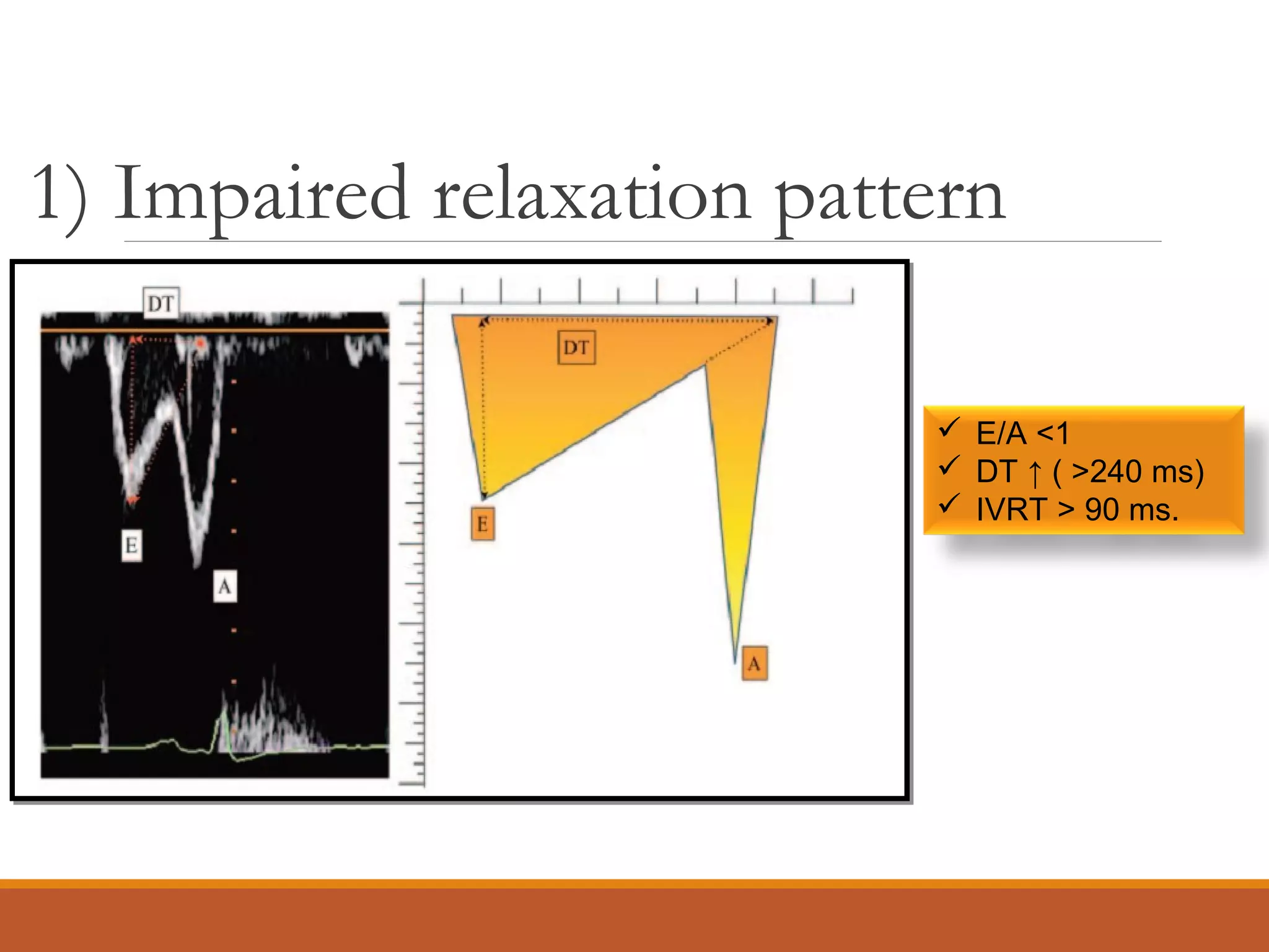 1) Impaired relaxation pattern
 E/A <1
 DT ↑ ( >240 ms)
 IVRT > 90 ms.
 