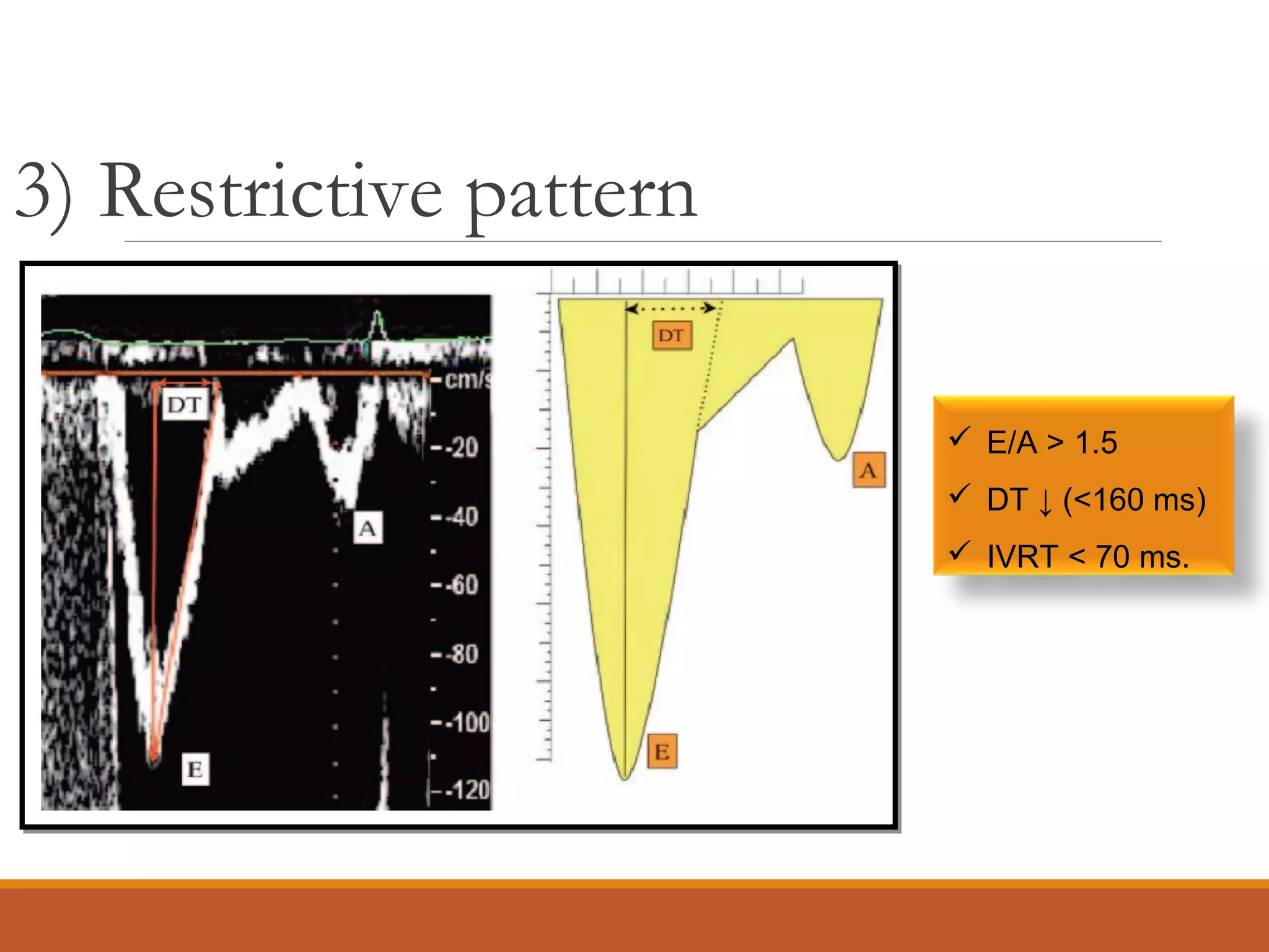 3) Restrictive pattern
 E/A > 1.5
 DT ↓ (<160 ms)
 IVRT < 70 ms.
 
