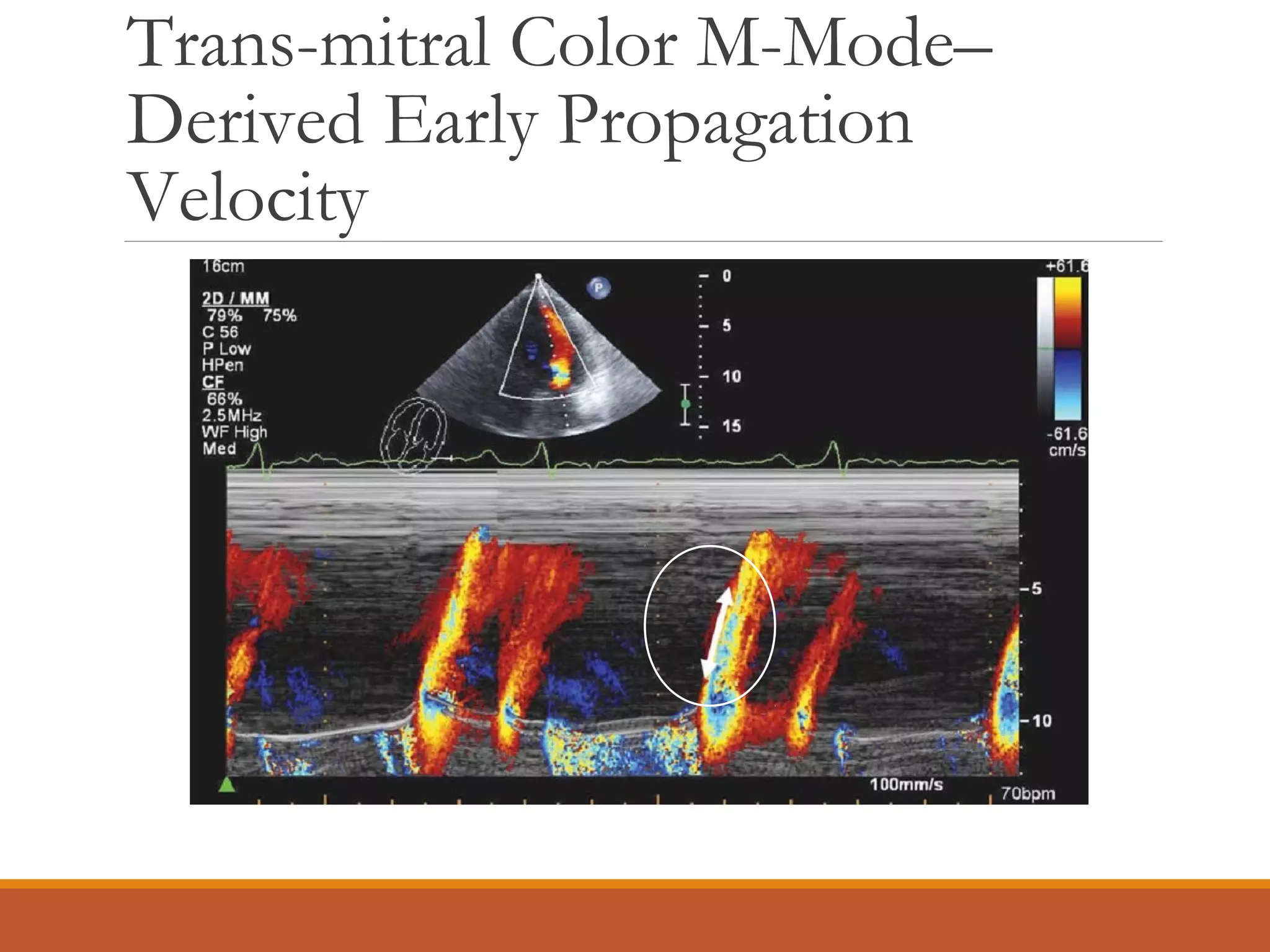 Trans-mitral Color M-Mode–
Derived Early Propagation
Velocity
 