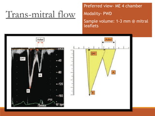 Trans-mitral flow
Preferred view- ME 4 chamber
Modality- PWD
Sample volume: 1-3 mm @ mitral
leaflets
 