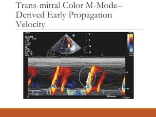 Trans-mitral Color M-Mode–
Derived Early Propagation
Velocity
 