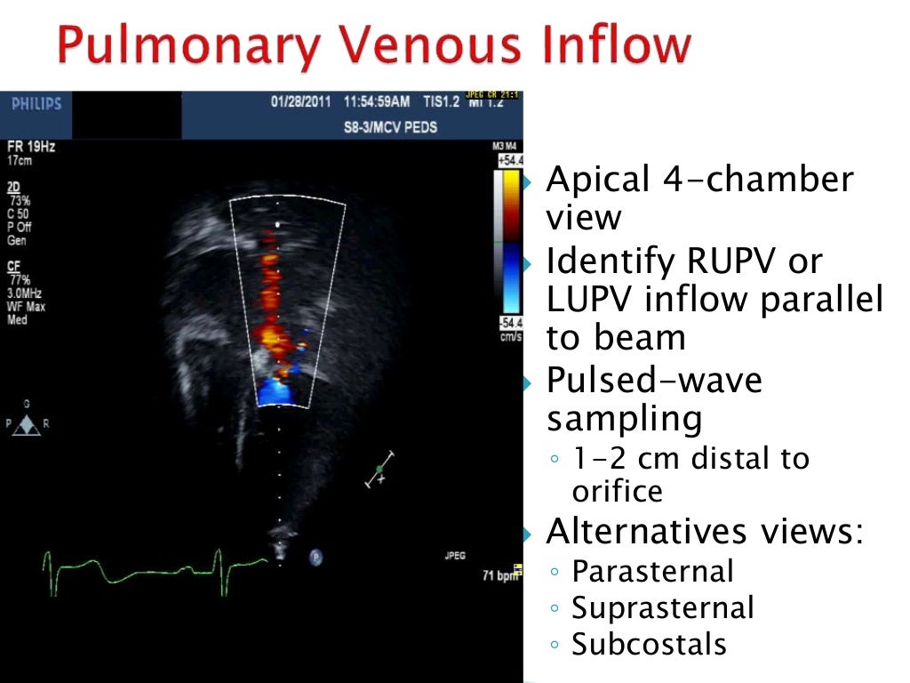 ECHOCARDIOGRAPHIC EVALUATION Of LEFT VENTRICULAR DIASTOLIC FUNCTION T Echocardiographic evaluation of left ventricular diastolic function t