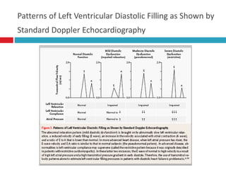 Patterns of Left Ventricular Diastolic Filling as Shown by
Standard Doppler Echocardiography
 