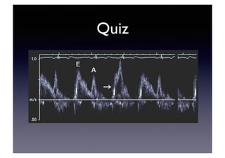 Echocardiographic Evaluation of LV Diastolic Function | PDF