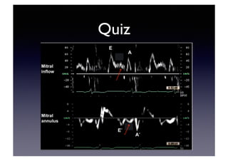 Echocardiographic Evaluation of LV Diastolic Function | PDF