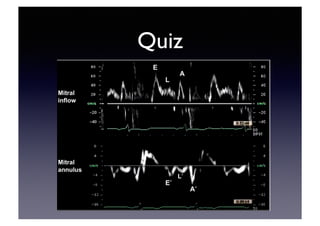 Echocardiographic Evaluation of LV Diastolic Function | PDF