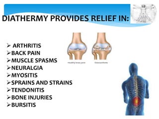 DIATHERMY PROVIDES RELIEF IN: 
 ARTHRITIS 
BACK PAIN 
MUSCLE SPASMS 
NEURALGIA 
MYOSITIS 
SPRAINS AND STRAINS 
TENDONITIS 
BONE INJURIES 
BURSITIS 
 