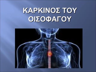ΚΑΡΚΙΝΟΣ ΤΟΥΚΑΡΚΙΝΟΣ ΤΟΥ
ΟΙΣΟΦΑΓΟΥΟΙΣΟΦΑΓΟΥ
 