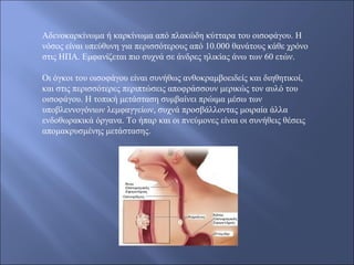 Αδενοκαρκίνωμα ή καρκίνωμα από πλακώδη κύτταρα του οισοφάγου. Η
νόσος είναι υπεύθυνη για περισσότερους από 10.000 θανάτους κάθε χρόνο
στις ΗΠΑ. Εμφανίζεται πιο συχνά σε άνδρες ηλικίας άνω των 60 ετών.
Οι όγκοι του οισοφάγου είναι συνήθως ανθοκραμβοειδείς και διηθητικοί,
και στις περισσότερες περιπτώσεις αποφράσσουν μερικώς τον αυλό του
οισοφάγου. Η τοπική μετάσταση συμβαίνει πρώιμα μέσω των
υποβλεννογόνιων λεμφαγγείων, συχνά προσβάλλοντας μοιραία άλλα
ενδοθωρακικά όργανα. Το ήπαρ και οι πνεύμονες είναι οι συνήθεις θέσεις
απομακρυσμένης μετάστασης.
 