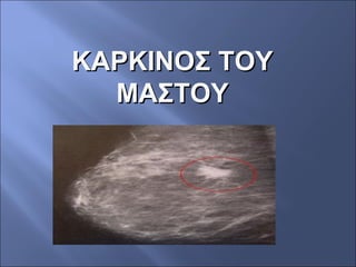 ΚΑΡΚΙΝΟΣ ΤΟΥΚΑΡΚΙΝΟΣ ΤΟΥ
ΜΑΣΤΟΥΜΑΣΤΟΥ
 