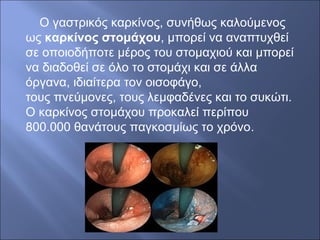 Ο γαστρικός καρκίνος, συνήθως καλούμενος
ως καρκίνος στομάχου, μπορεί να αναπτυχθεί
σε οποιοδήποτε μέρος του στομαχιού και μπορεί
να διαδοθεί σε όλο το στομάχι και σε άλλα
όργανα, ιδιαίτερα τον οισοφάγο,
τους πνεύμονες, τους λεμφαδένες και το συκώτι.
Ο καρκίνος στομάχου προκαλεί περίπου
800.000 θανάτους παγκοσμίως το χρόνο.
 