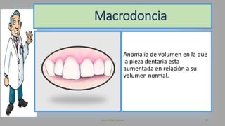 Anomalía de volumen en la que
la pieza dentaria esta
aumentada en relación a su
volumen normal.
Valeria Díaz Cabrera 18
Macrodoncia
 
