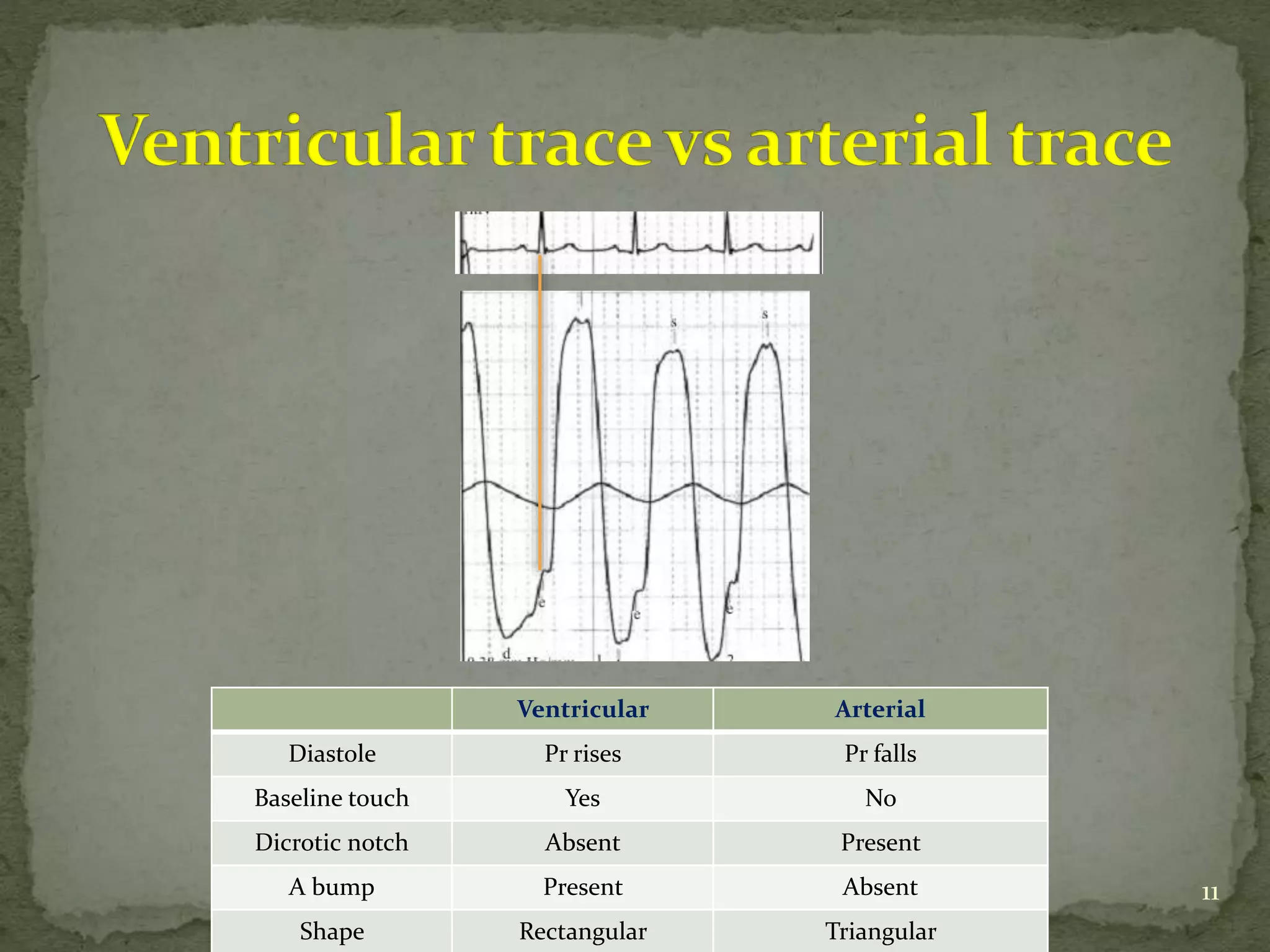 Ventricular Arterial
Diastole Pr rises Pr falls
Baseline touch Yes No
Dicrotic notch Absent Present
A bump Present Absent
Shape Rectangular Triangular
11
 