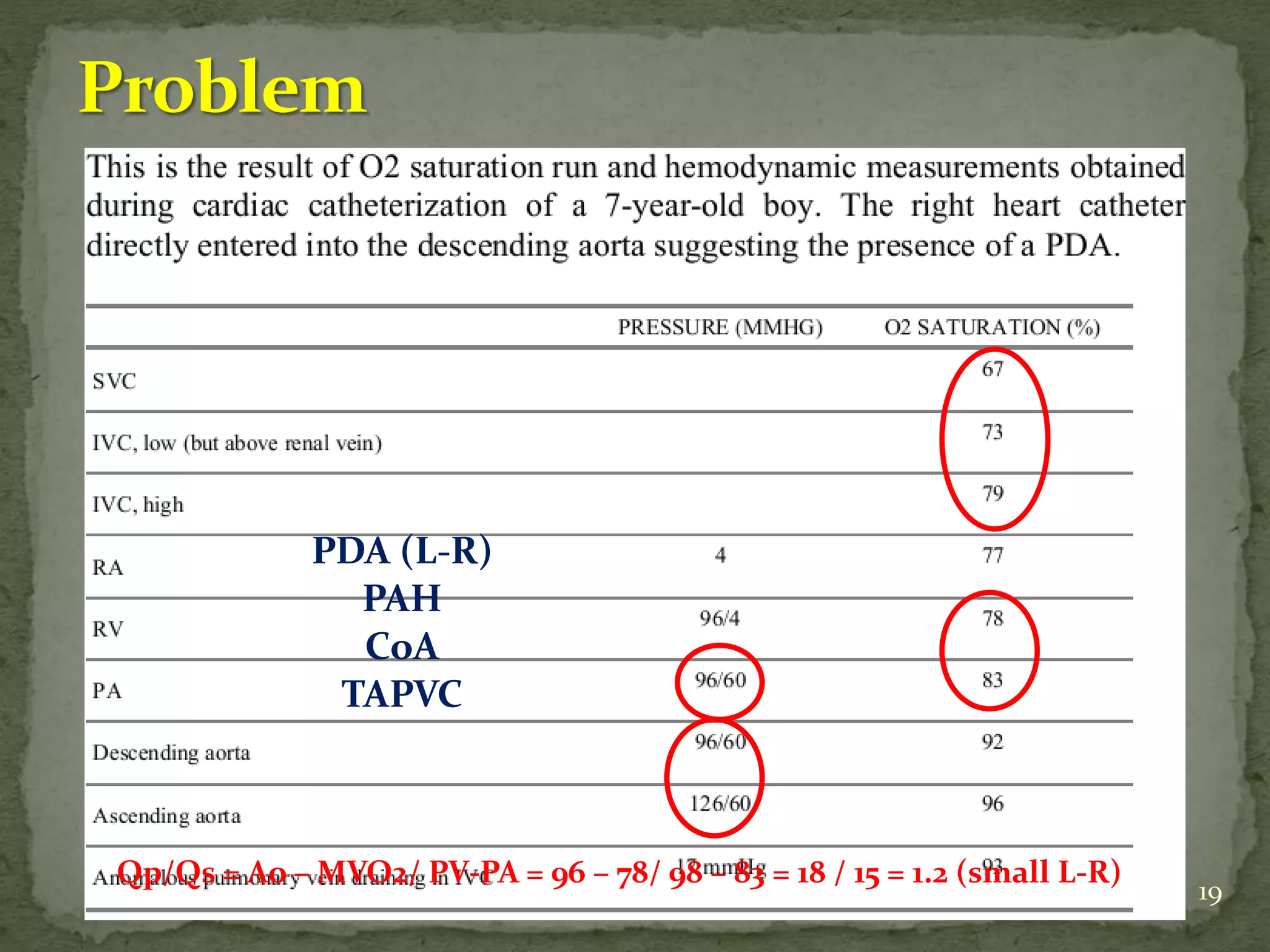19
Qp/Qs = Ao – MVO2/ PV-PA = 96 – 78/ 98 – 83 = 18 / 15 = 1.2 (small L-R)
PDA (L-R)
PAH
CoA
TAPVC
 